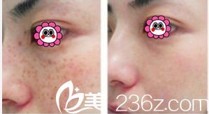 激光祛斑价格详解与步骤指南