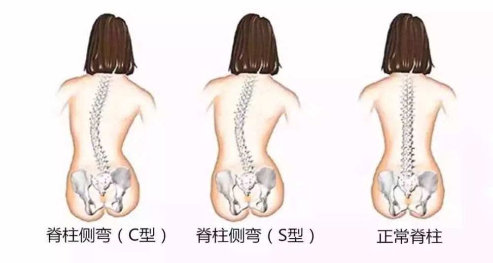 最新脊柱侧弯治疗方法及其奇妙之旅