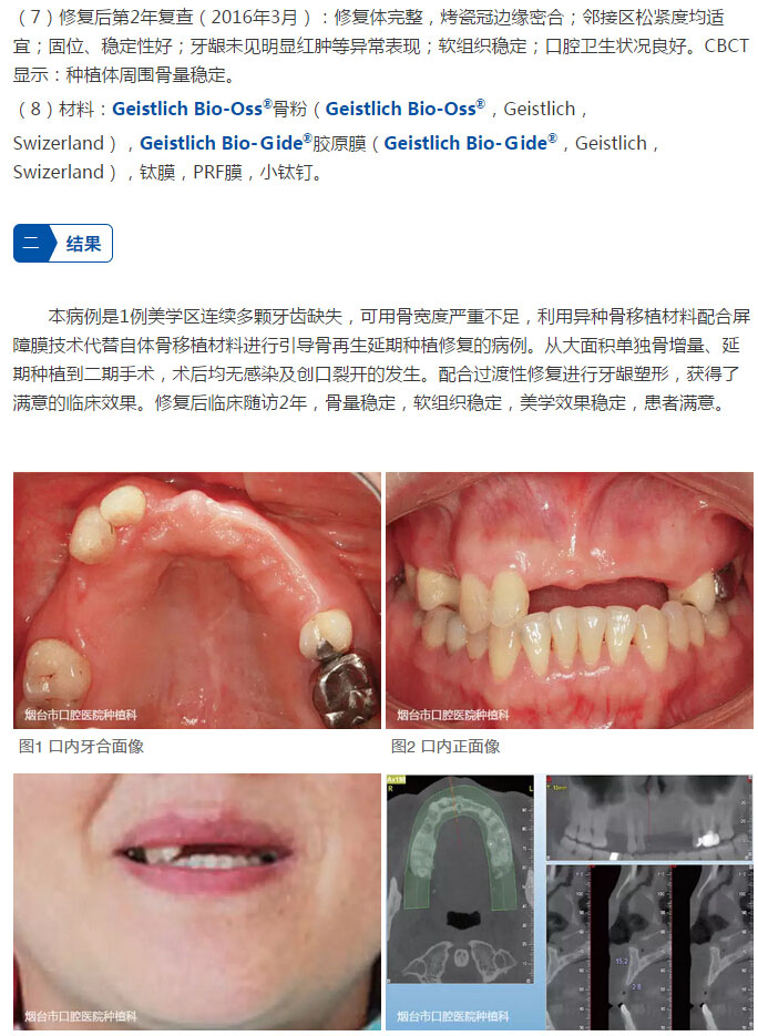 最新再生牙技术，笑迎人生，勇敢追求学习与变化的力量